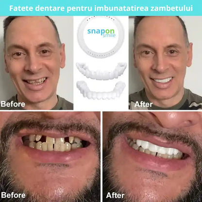 Snap On Smile - Snap On Smile